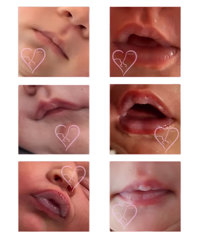 Zungenband- / Lippenbandproblematik (orale Restriktionen) von Doreen Gabor